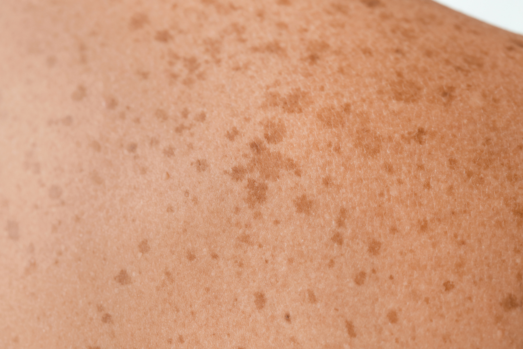 Close Up of Human Skin with Freckles